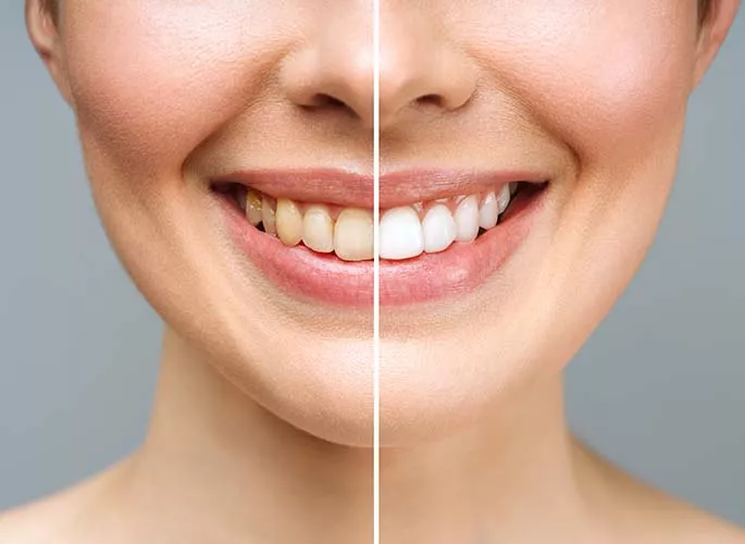 teeth whitening in Dartmouth